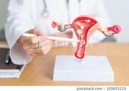 Doctor with Uterus and Ovaries anatomy model. Ovarian and Cervical cancer, Cervix disorder, Endometriosis, Hysterectomy, Uterine fibroids, Reproductive system, Pregnancy and health concept 103653219