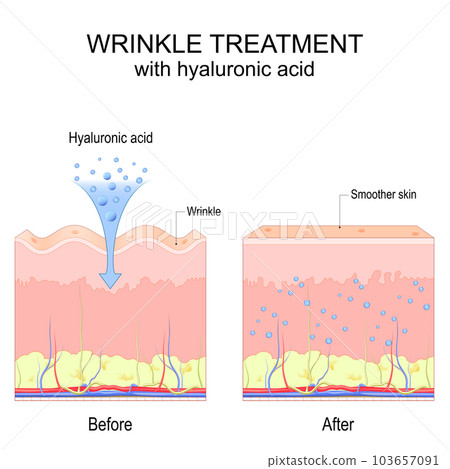 Wrinkle treatment with hyaluronic acid Wrinkle treatment with hyaluronic acid 103657091