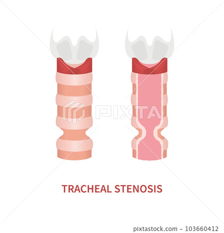 Trachea narrowing awareness icon of tracheal stenosis 103660412