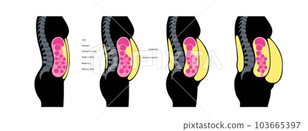 Visceral fat diagram Visceral fat diagram 103665397