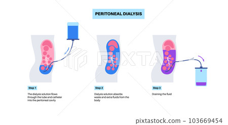 Peritoneal dialysis concept Peritoneal dialysis concept 103669454