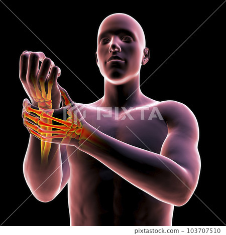A man experiencing wrist pain, 3D illustration A man experiencing wrist pain, 3D illustration 103707510