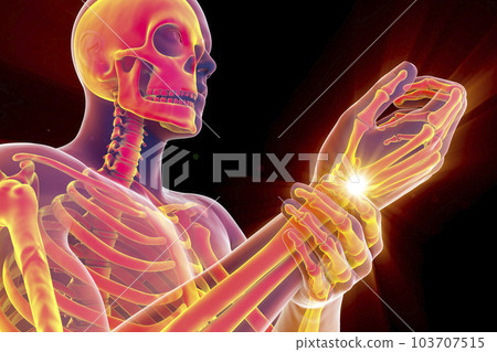 A man experiencing wrist pain, 3D illustration A man experiencing wrist pain, 3D illustration 103707515