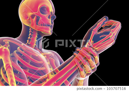 A man experiencing wrist pain, 3D illustration 103707516