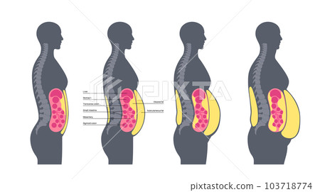 Visceral fat diagram Visceral fat diagram 103718774