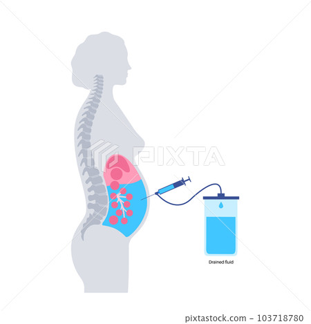 Abdominal paracentesis poster Abdominal paracentesis poster 103718780
