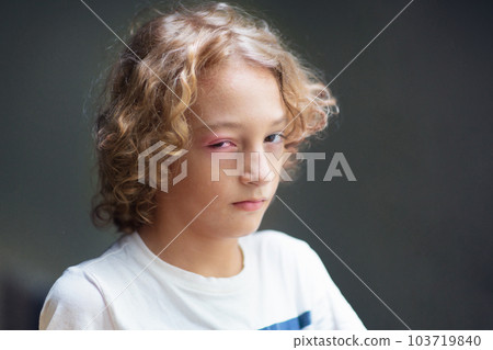 Child with swollen pink eye. Eyes infection. Child with swollen pink eye. Eyes infection. 103719840
