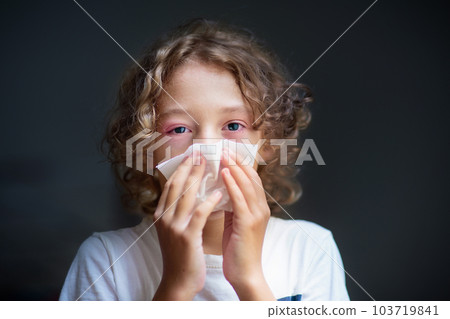 Child with swollen pink eye. Eyes infection. Child with swollen pink eye. Eyes infection. 103719841