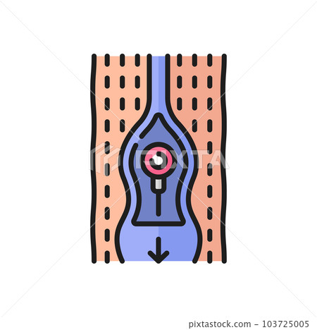 Abnormal blood flow, thrombosis and cardiovascular disease color outline icon. Vector varicose vein not closed damaged valve, blood flowing in both directions 103725005
