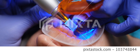 Dentist treating caries and illuminating seal with ultraviolet lamp closeup Dentist treating caries and illuminating seal with ultraviolet lamp closeup 103748844