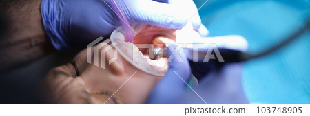 Dentist treating teeth with machine and tools closeup 103748905