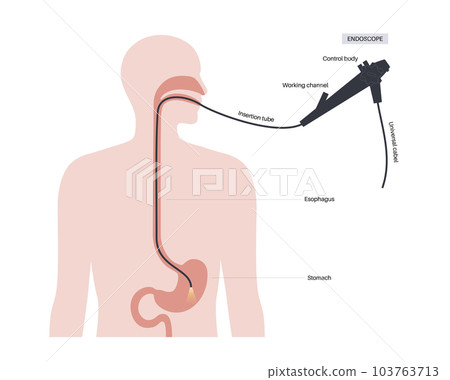 Gastroscopy endoscopy procedure Gastroscopy endoscopy procedure 103763713