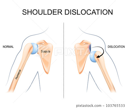 Shoulder dislocation. humerus bone trauma, 103765533