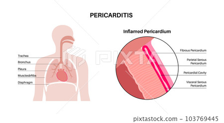 Pericarditis heart disease Pericarditis heart disease 103769445