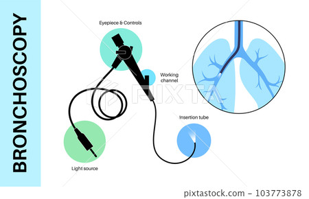 Bronchoscopy procedure concept 103773878