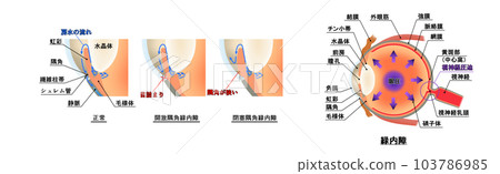 青光眼圖，信息圖表 103786985