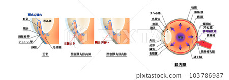 青光眼圖,信息圖表 青光眼圖,信息圖表 103786987