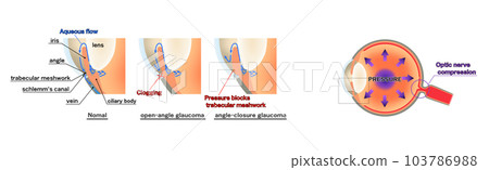 Glaucoma diagram, infographic, English 103786988