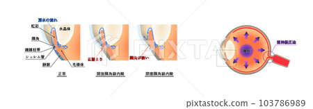 Glaucoma diagram, infographic Glaucoma diagram, infographic 103786989