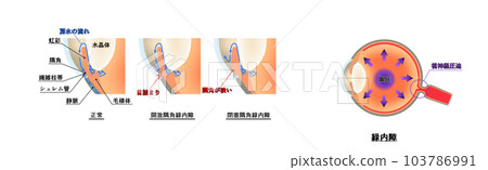 Glaucoma diagram, infographic Glaucoma diagram, infographic 103786991