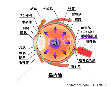 Glaucoma diagram, infographic Glaucoma diagram, infographic 103787003