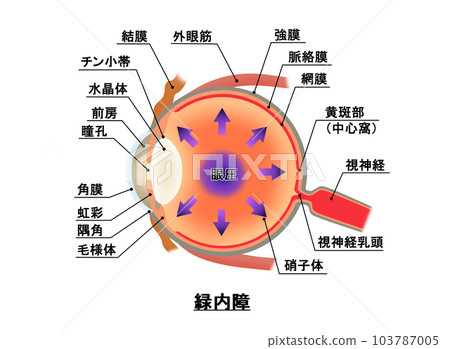 青光眼圖,信息圖表 青光眼圖,信息圖表 103787005