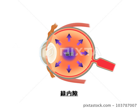 青光眼圖,信息圖表 青光眼圖,信息圖表 103787007