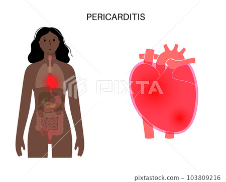 Pericarditis heart disease Pericarditis heart disease 103809216