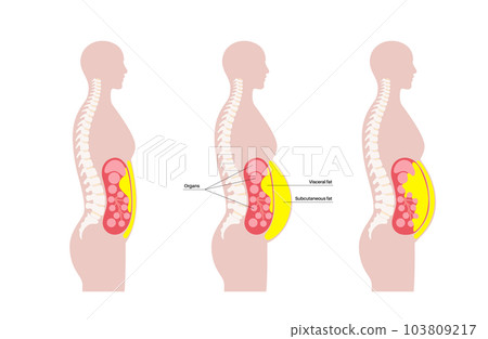 Visceral fat diagram 103809217