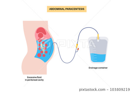 Abdominal paracentesis poster 103809219