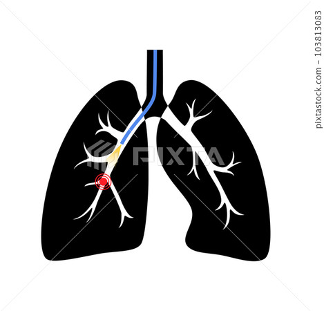 Bronchoscopy procedure concept Bronchoscopy procedure concept 103813083