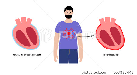 Pericarditis heart disease 103853445