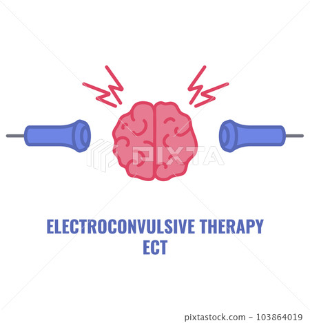 ECT electroconvulsive therapy for severe depression treatment 103864019