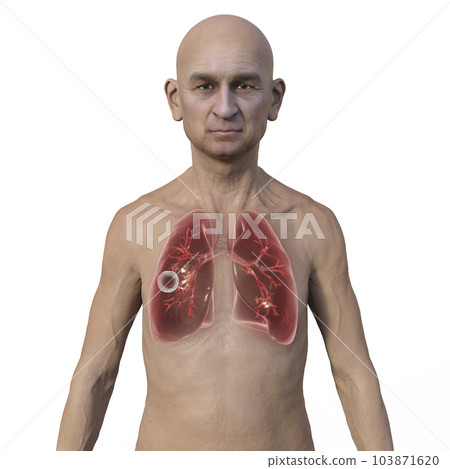 A 3D illustration of the upper half of a man with transparent skin, showcasing the lungs affected by cavernous tuberculosis A 3D illustration of the upper half of a man with transparent skin, showcasing the lungs affected by cavernous tuberculosis 103871620