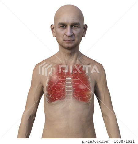 A 3D illustration showcasing the upper half part of a man with transparent skin, revealing the lungs affected by miliary tuberculosis A 3D illustration showcasing the upper half part of a man with transparent skin, revealing the lungs affected by miliary tuberculosis 103871621