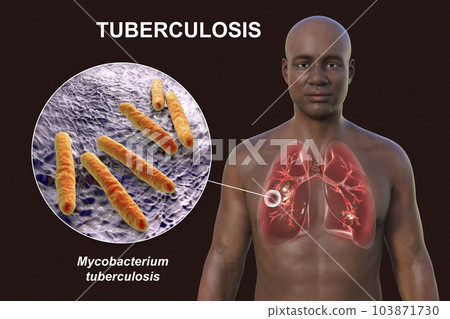 A 3D illustration of the upper half of a man with transparent skin, showcasing the lungs affected by cavernous tuberculosis, and close-up view of Mycobacterium tuberculosis bacteria 103871730