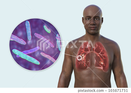 A 3D illustration of the upper half of a man with transparent skin, showcasing the lungs affected by cavernous tuberculosis, and close-up view of Mycobacterium tuberculosis bacteria A 3D illustration of the upper half of a man with transparent skin, showcasing the lungs affected by cavernous tuberculosis, and close-up view of Mycobacterium tuberculosis bacteria 103871731
