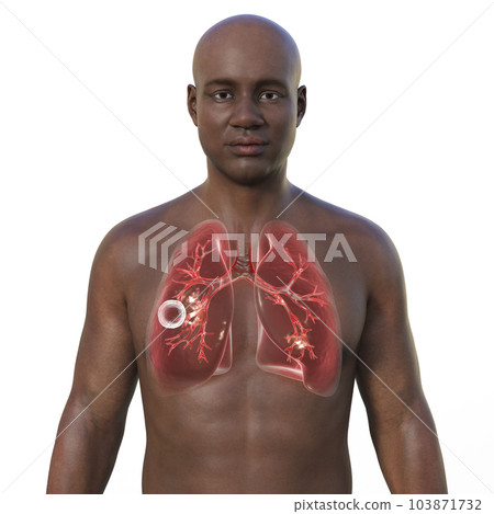 A 3D illustration of the upper half of a man with transparent skin, showcasing the lungs affected by cavernous tuberculosis A 3D illustration of the upper half of a man with transparent skin, showcasing the lungs affected by cavernous tuberculosis 103871732
