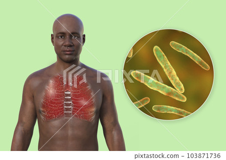 A 3D illustration of a man with transparent skin, showcasing the lungs affected by miliary tuberculosis and close-up view of Mycobacterium tuberculosis bacteria 103871736
