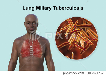 A 3D illustration of a man with transparent skin, showcasing the lungs affected by miliary tuberculosis and close-up view of Mycobacterium tuberculosis bacteria A 3D illustration of a man with transparent skin, showcasing the lungs affected by miliary tuberculosis and close-up view of Mycobacterium tuberculosis bacteria 103871737