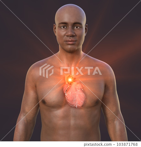 A 3D illustration of the upper half part of an African man with transparent skin, revealing an ascending aortic aneurysm A 3D illustration of the upper half part of an African man with transparent skin, revealing an ascending aortic aneurysm 103871768
