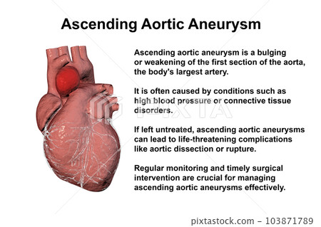A human heart with an ascending aortic aneurysm, 3D illustration A human heart with an ascending aortic aneurysm, 3D illustration 103871789