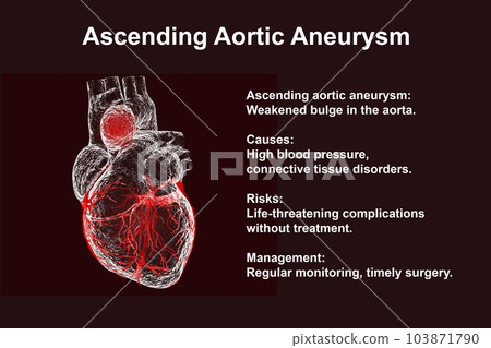 A human heart with an ascending aortic aneurysm, 3D illustration 103871790