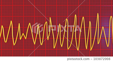 Electrocardiogram ECG displaying Torsades de pointes rhythm, 3D illustration 103872008