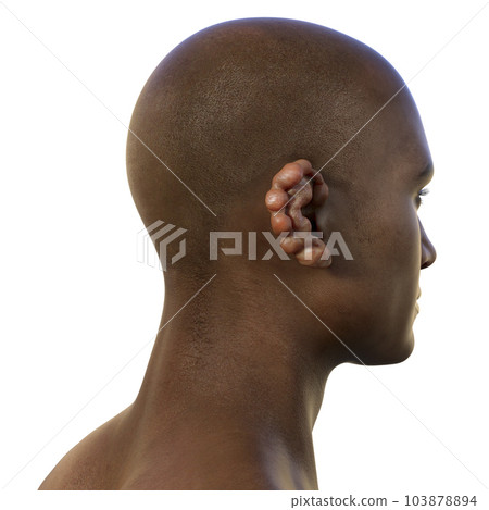 Ear lobomycosis nodules, a chronic skin disease caused by microscopic fungi Lacazia loboi, 3D illustration Ear lobomycosis nodules, a chronic skin disease caused by microscopic fungi Lacazia loboi, 3D illustration 103878894