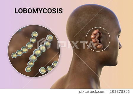 Lobomycosis, a chronic skin disease caused by microscopic fungi Lacazia loboi and characterized by nodular skin lesions, 3D illustration 103878895