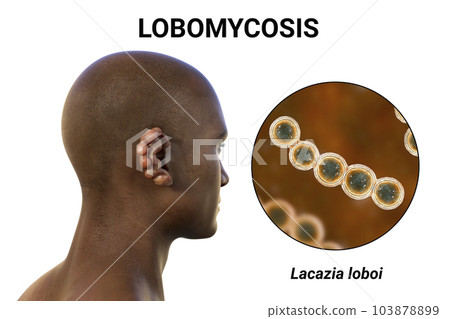 Lobomycosis, a chronic skin disease caused by microscopic fungi Lacazia loboi and characterized by nodular skin lesions, 3D illustration 103878899