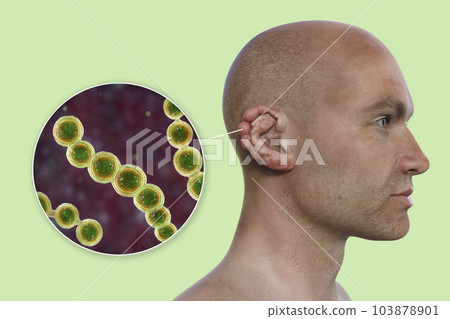 Lobomycosis, a chronic skin disease caused by microscopic fungi Lacazia loboi and characterized by nodular skin lesions, 3D illustration 103878901
