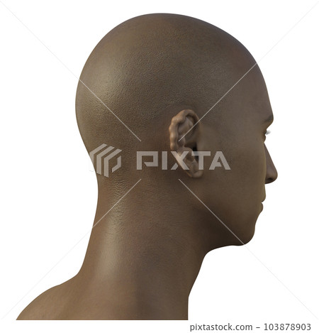 Ear lobomycosis nodules, a chronic skin disease caused by microscopic fungi Lacazia loboi, 3D illustration Ear lobomycosis nodules, a chronic skin disease caused by microscopic fungi Lacazia loboi, 3D illustration 103878903