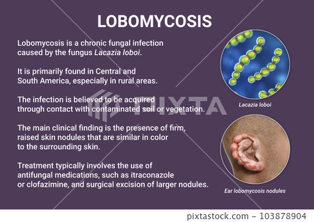 Lobomycosis, a chronic skin disease caused by microscopic fungi Lacazia loboi and characterized by nodular skin lesions, 3D illustration Lobomycosis, a chronic skin disease caused by microscopic fungi Lacazia loboi and characterized by nodular skin lesions, 3D illustration 103878904